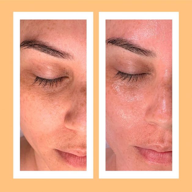 hydrafacial antes y despues