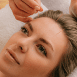 Acupuntura facial | Treatwell
