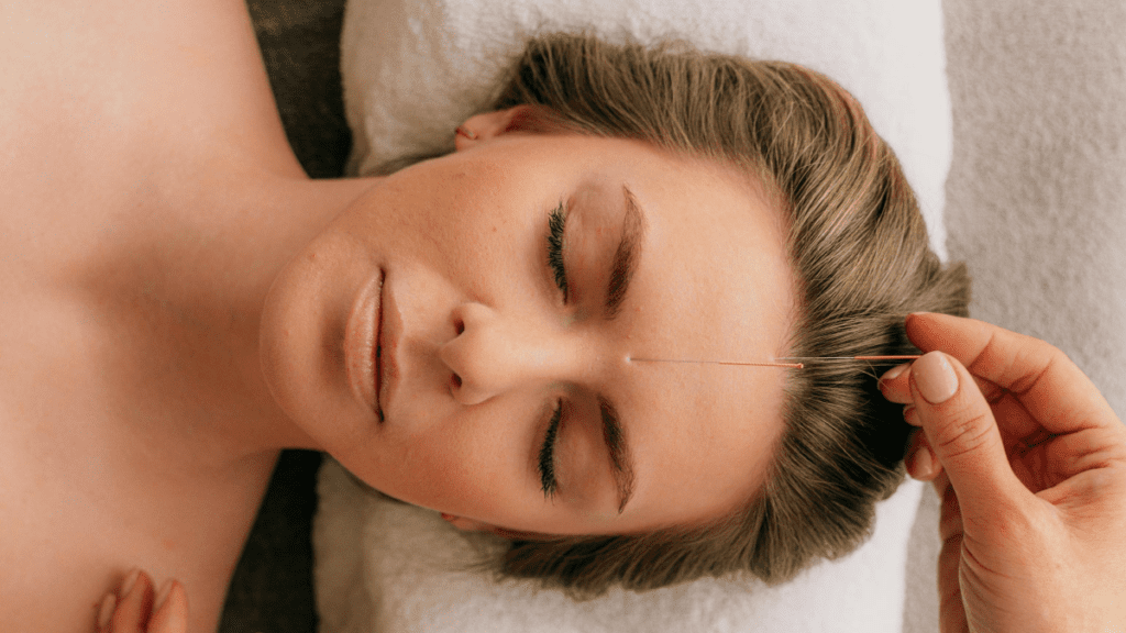 Acupuntura facial_3 | Treatwell